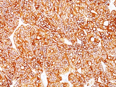 Formalin-fixed, paraffin-embedded human Colon Carcinoma stained with Cytokeratin 18 Monoclonal Antibody (Cocktail).