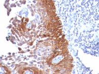 Formalin-fixed, paraffin-embedded human Cervical Carcinoma stained with Cytokeratin 18 Monoclonal Antibody (Cocktail).