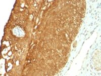 Formalin-fixed, paraffin-embedded human Cervical Carcinoma stained with Cytokeratin 19 Monoclonal Antibody (KRT19/8)