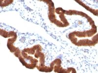 Formalin-fixed, paraffin-embedded human Ovarian Carcinoma stained with Cytokeratin 19 Monoclonal Antibody (KRT19/799 + KRT19/8)