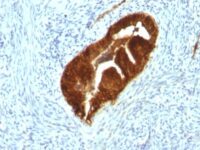 Formalin-fixed, paraffin-embedded human Endometrial Carcinoma stained with Cytokeratin 19 Monoclonal Antibody (KRT19/799 + KRT19/8)