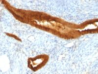 Formalin-fixed, paraffin-embedded human Endometrial Carcinoma stained with Epcam Monoclonal Antibody (MOC-31).