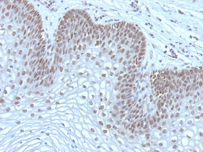 Formalin-fixed, paraffin-embedded human Cervical Carcinoma stained with MAP3K1 Monoclonal Antibody (2F6).