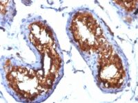 Formalin-fixed, paraffin-embedded human Testicular Carcinoma & stained with CD99 Monoclonal Antibody (MIC2/877).