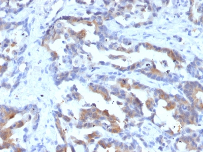 Formalin-fixed, paraffin-embedded Human Rectal Carcinoma stained with MRP1/ABCC1 Monoclonal Antibody (MRP1/1343).