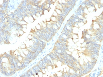 Formalin-fixed, paraffin-embedded Human Colon Carcinoma stained with MRP1/ABCC1 Monoclonal Antibody (MRP1/1343).