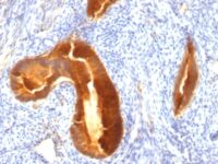 Formalin-fixed, paraffin-embedded human Endometrial Carcinoma stained with EMA Monoclonal Antibody (MUC1/955).