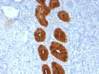 Formalin-fixed, paraffin-embedded human Endometrial Carcinoma stained with EMA Monoclonal Antibody (MUC1/967).