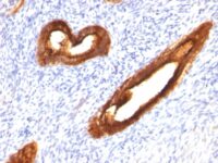 Formalin-fixed, paraffin-embedded human Endometrial Carcinoma stained with MUC-1 / EMA Monoclonal Antibody (MUC1/52).