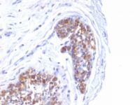 Formalin-fixed, paraffin-embedded human Breast Carcinoma stained with MUC-1 / EMA Monoclonal Antibody (MUC1/52).