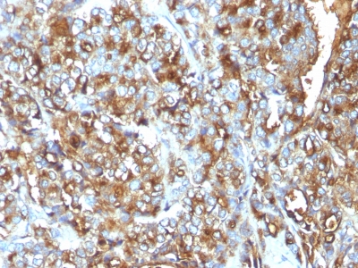 Formalin-fixed, paraffin-embedded human Breast Carcinoma stained with MUC-1 / EMA Monoclonal Antibody (MUC1/52).