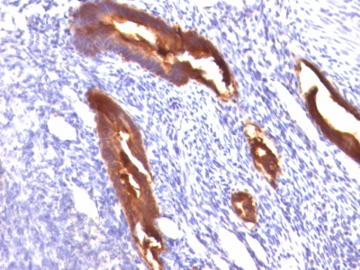 Formalin-fixed, paraffin-embedded human Endometrial Carcinoma stained with MUC1 / EMA Monoclonal Antibody (MUC1/845).