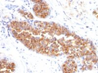 Formalin-fixed, paraffin-embedded human Breast Carcinoma stained with MUC1 / EMA Monoclonal Antibody (MUC1/845).