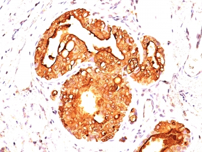 Formalin-fixed, paraffin-embedded human Breast Carcinoma stained with MUC1 / EMA Monoclonal Antibody (MUC1/845).