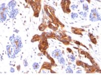 Formalin-fixed, paraffin-embedded human Breast Carcinoma stained with MUC1 / EMA Monoclonal Antibody (MUC1/845).