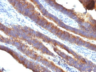 Formalin-fixed, paraffin-embedded human Colon Carcinoma stained with MUC3 Monoclonal Antibody (M3.1).