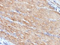 Formalin-fixed, paraffin-embedded human Colon Carcinoma stained with SM-MHC Monoclonal Antibody (MYH11/923).