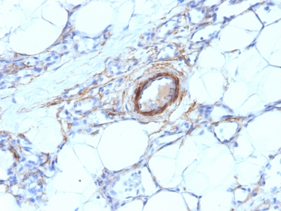 Formalin-fixed, paraffin-embedded human Angiosarcoma stained with SM-MHC Monoclonal Antibody (MYH11/923).