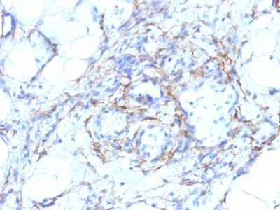 Formalin-fixed, paraffin-embedded human Angiosarcoma stained with SM-MHC Monoclonal Antibody (MYH11/923 + SMMS-1).