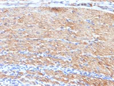 Formalin-fixed, paraffin-embedded human Colon Carcinoma stained with SM-MHC Monoclonal Antibody (MYH11/923 + SMMS-1).