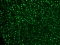 Formalin-fixed paraffin-embedded human Colon Carcinoma stained with AF488 Conjugate of Nucleolin Monoclonal Antibody (364-5).