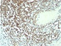 Formalin-fixed, paraffin-embedded human Bladder Carcinoma stained with Nucleolin Monoclonal Antibody (364-5 + NCL/92).