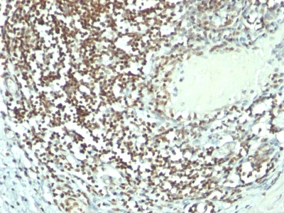Formalin-fixed, paraffin-embedded human Bladder Carcinoma stained with Nucleolin Monoclonal Antibody (364-5 + NCL/92).
