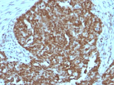 Formalin-fixed, paraffin-embedded human Ovarian Carcinoma stained with Nucleolin Monoclonal Antibody (364-5 + NCL/92).
