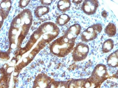 Formalin-paraffin human Duodenal Carcinoma stained with TDP2 MAb (TDP2/1258)