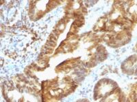 Formalin-paraffin human Colon Carcinoma stained with TDP2 MAb (TDP2/1258)