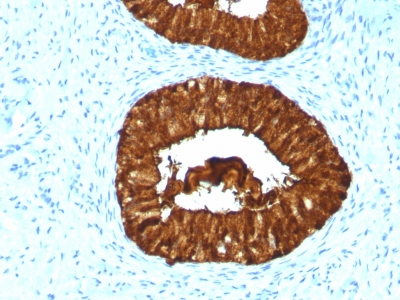 Formalin-fixed, paraffin-embedded Human Cervical Carcinoma stained with MAML3 Monoclonal Antibody (MAML3/133).