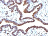 Formalin-fixed, paraffin-embedded human Ovarian Carcinoma stained with SUMO-2 Monoclonal Antibody (SUMO2/1199)