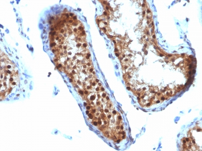 Formalin-fixed, paraffin-embedded human Testicular Carcinoma stained with SUMO-2 Monoclonal Antibody (SUMO2/1199)