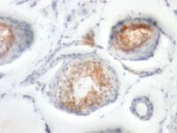 Formalin-fixed, paraffin-embedded human Testicular Carcinoma stained with CD147 Monoclonal Antibody (BSG/963).