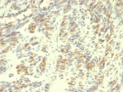 Formalin-fixed, paraffin-embedded human Leiomyosarcoma stained with Transglutaminase II Monoclonal Antibody (TGM2/419)