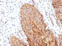 Formalin-fixed, paraffin-embedded human Bladder Carcinoma stained with Thrombomodulin Monoclonal/CD141 Antibody (THBD/1591).