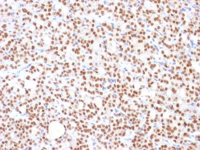 Formalin-fixed, paraffin-embedded human Thyroid Carcinoma stained with PAX8 Monoclonal Antibody (PAX8/1492).