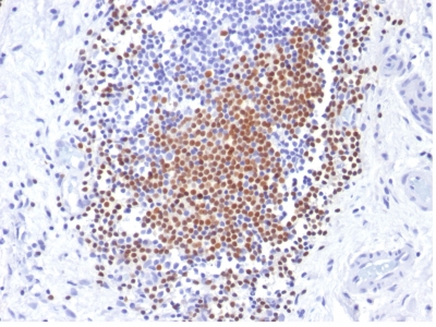Formalin-fixed, paraffin-embedded human Urothelial Carcinoma stained with PAX8 Monoclonal Antibody (PAX8/1492).