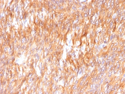 Formalin-fixed, paraffin-embedded human Small Intestinal Carcinoma stained with Calnexin Monoclonal Antibody (CANX/1541).