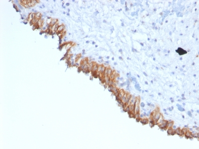 Formalin-fixed, paraffin-embedded Human Bladder Carcinoma stained with MAML2 Monoclonal Antibody (MAML2/132).