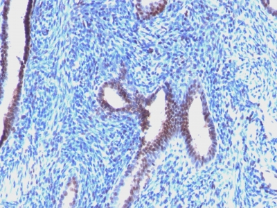 Formalin-fixed, paraffin-embedded human Endometrial Carcinoma stained with Cyclin B1 Monoclonal Antibody (CCNB1/198)