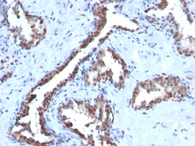Formalin-fixed, paraffin-embedded human Prostate Carcinoma stained with Cyclin B1 Monoclonal Antibody (CCNB1/198)