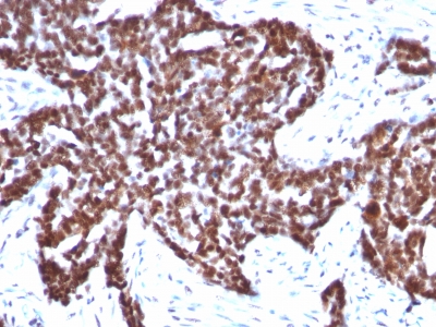 Formalin-fixed, paraffin-embedded human Ovarian Carcinoma stained with Cyclin B1 Monoclonal Antibody (CCNB1/198)