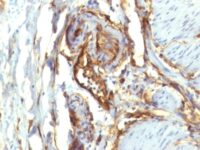 Formalin-fixed, paraffin-embedded human Colon Carcinoma stained with CD34 Monoclonal Antibody (QBEnd/1 + HPCA1/763)