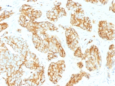 Formalin-paraffin human Prostate Carcinoma stained with CD44 Monoclonal Antibody (CD44v9/1459)