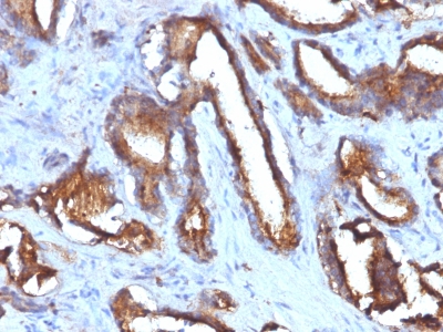 Formalin-fixed, paraffin-embedded human Prostate Carcinoma stained with CD63 Monoclonal Antibody (NKI/C3 + LAMP3/968)