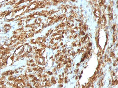 Formalin-fixed, paraffin-embedded human Rhabdomyosarcoma stained with Muscle Specific Actin Monoclonal Antibody (HHF35 + MSA/953)