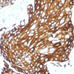 Low Molecular Weight (Acidic) Cytokeratin staining by anti-human cytokeratin recombinant monoclonal antibody. Sample is cross section of human lung carcicnoma (formalin fixed, paraffin embedded).