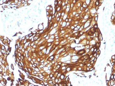 Low Molecular Weight (Acidic) Cytokeratin staining by anti-human cytokeratin recombinant monoclonal antibody. Sample is cross section of human lung carcicnoma (formalin fixed, paraffin embedded).