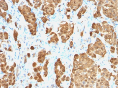 S100B staining by anti-human S100B antibody in FFPE tissue from human melanoma sample.